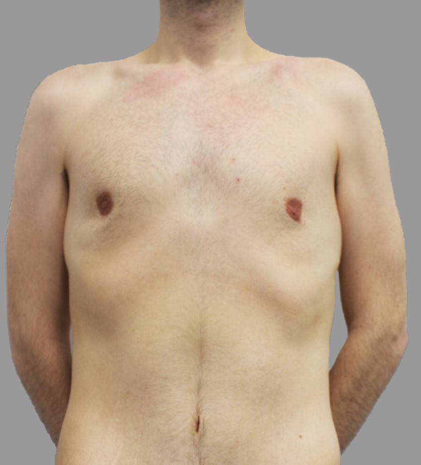 VASER Hi Def Lipo Before & After Patient #1513