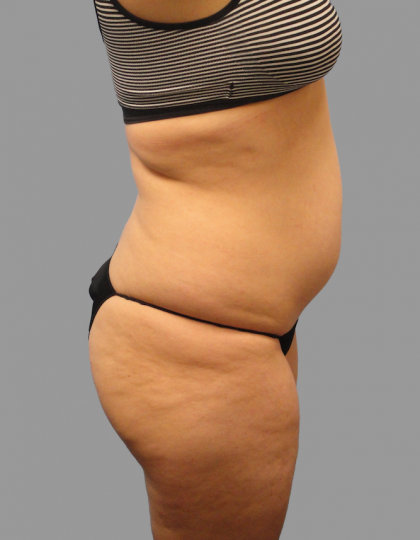 Liposuction Before & After Patient #1529