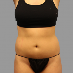 Liposuction Before & After Patient #1536