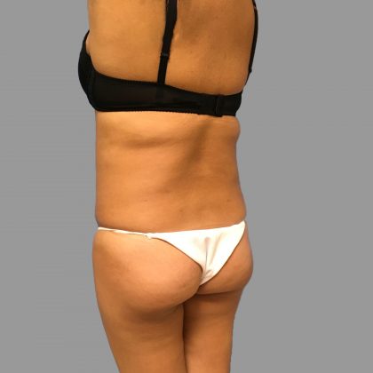 Brazilian Butt Lift Before & After Patient #1426