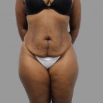 Tummy Tuck Before & After Patient #1608