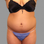 Liposuction Before & After Patient #1539