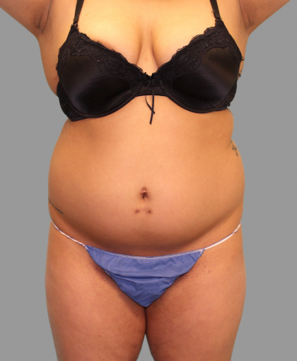 Liposuction Before & After Patient #1539