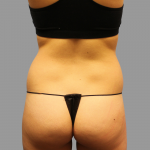 Liposuction Before & After Patient #1542