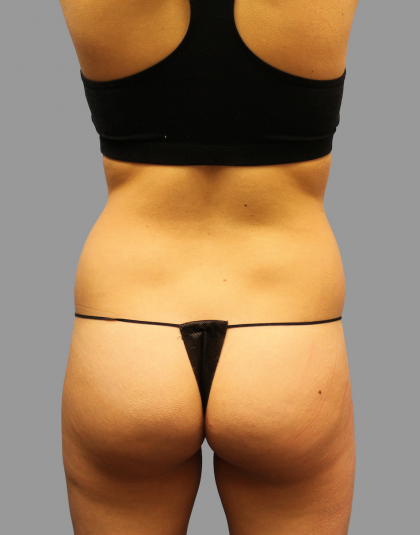 Liposuction Before & After Patient #1542