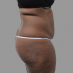 Liposuction Before & After Patient #1545