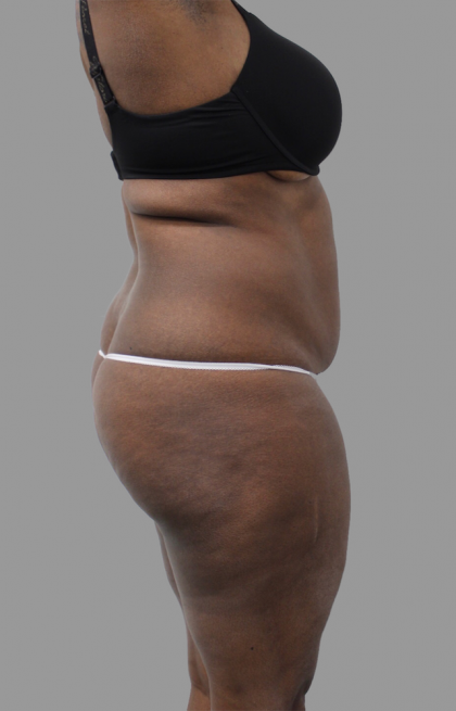 Liposuction Before & After Patient #1545