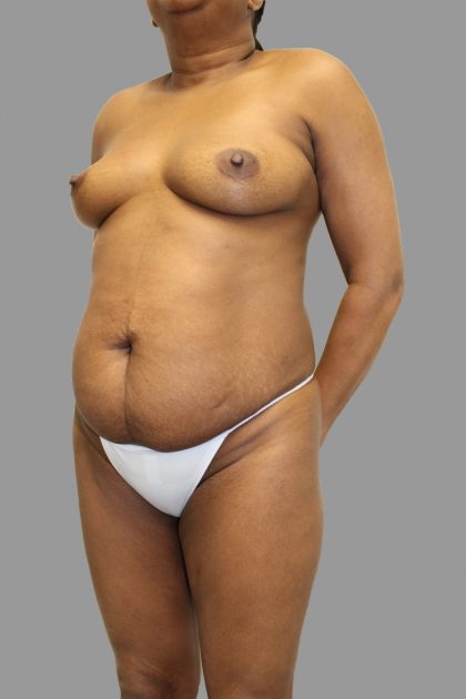 Tummy Tuck Before & After Patient #1613