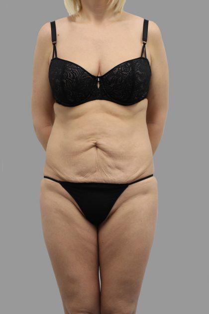 Tummy Tuck Before & After Patient #1621