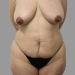 Tummy Tuck Before & After Patient #1582