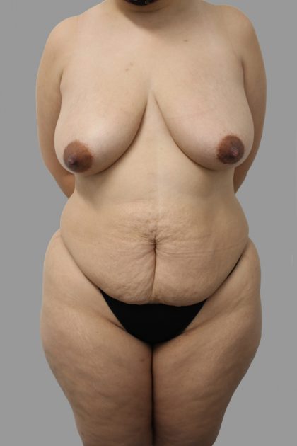 Tummy Tuck Before & After Patient #1582