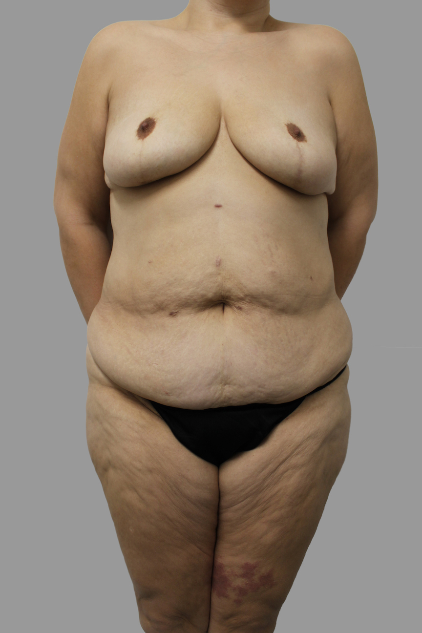 Tummy Tuck Before & After Patient #1658