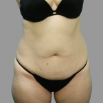 Tummy Tuck Before & After Patient #1585