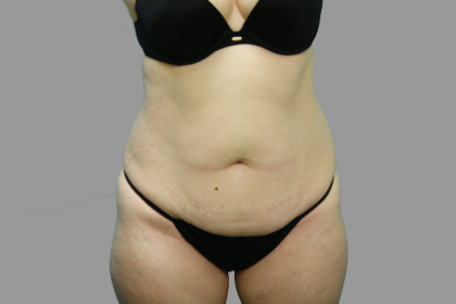 Tummy Tuck Before & After Patient #1585