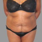 Tummy Tuck Before & After Patient #1588