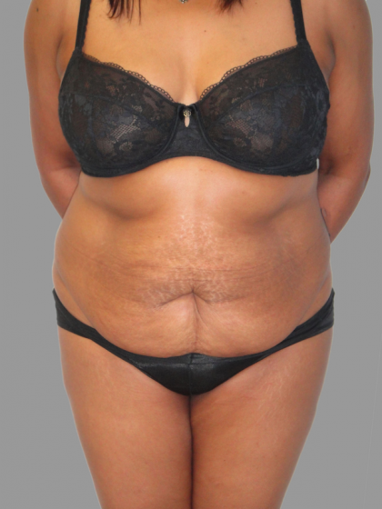 Tummy Tuck Before & After Patient #1588