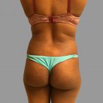 Brazilian Butt Lift Before & After Patient #1431