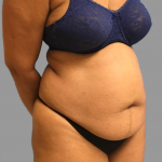 Tummy Tuck Before & After Patient #1593