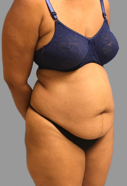 Tummy Tuck Before & After Patient #1593
