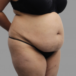 Tummy Tuck Before & After Patient #1599