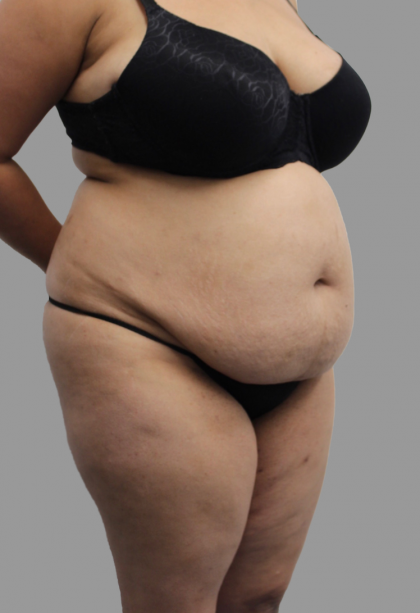 Tummy Tuck Before & After Patient #1599