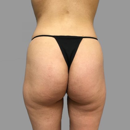 Brazilian Butt Lift Before & After Patient #1421