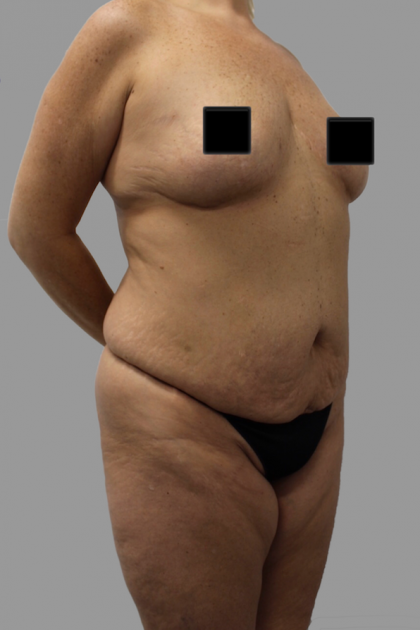 Tummy Tuck Before & After Patient #1605