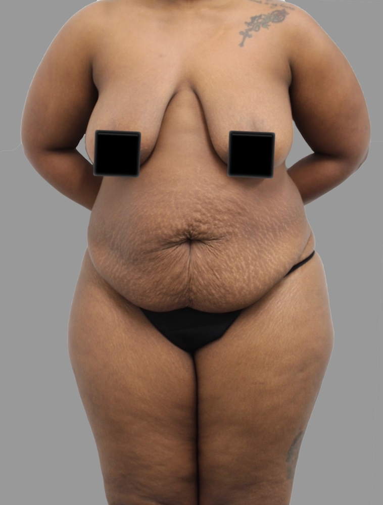 Tummy Tuck Before & After Patient #1618