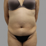 Tummy Tuck Before & After Patient #1624