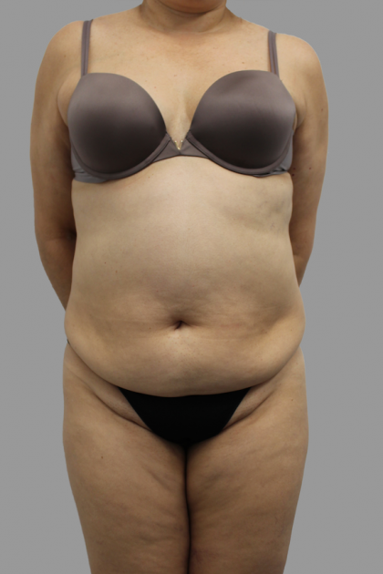 Tummy Tuck Before & After Patient #1624