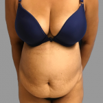 Tummy Tuck Before & After Patient #1627