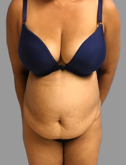 Tummy Tuck Before & After Patient #1627