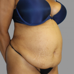 Tummy Tuck Before & After Patient #1627