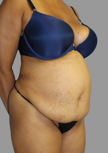 Tummy Tuck Before & After Patient #1627