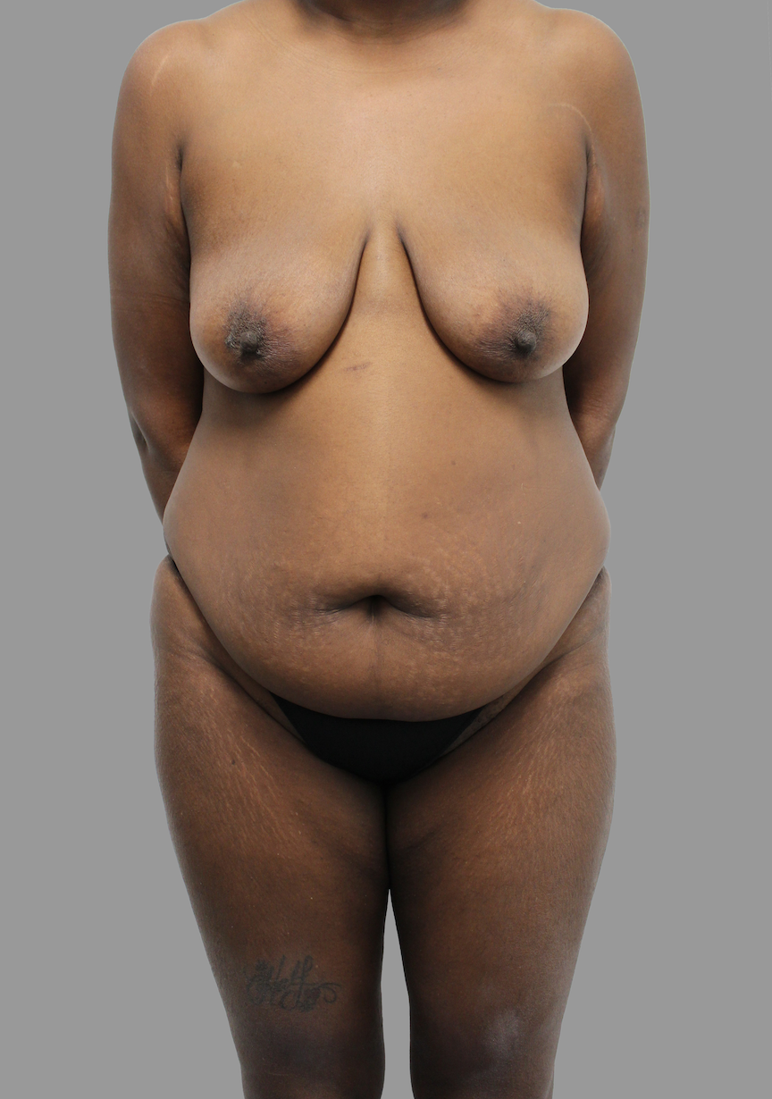 Tummy Tuck Before & After Patient #1635