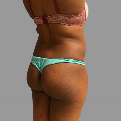 Brazilian Butt Lift Before & After Patient #1431