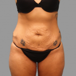 Tummy Tuck Before & After Patient #1638