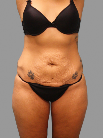 Tummy Tuck Before & After Patient #1638