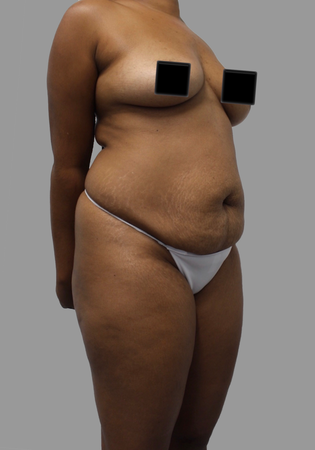 Tummy Tuck Before & After Patient #1644