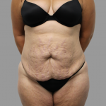 Tummy Tuck Before & After Patient #1655