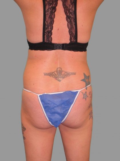 Brazilian Butt Lift Before & After Patient #1438