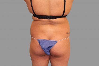 Brazilian Butt Lift Before & After Patient #1441