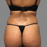 Brazilian Butt Lift Before & After Patient #1444