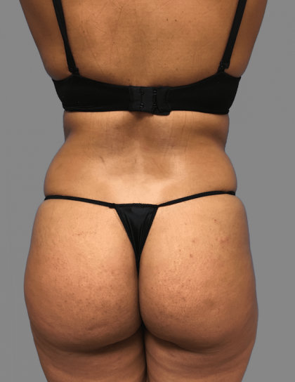 Brazilian Butt Lift Before & After Patient #1444