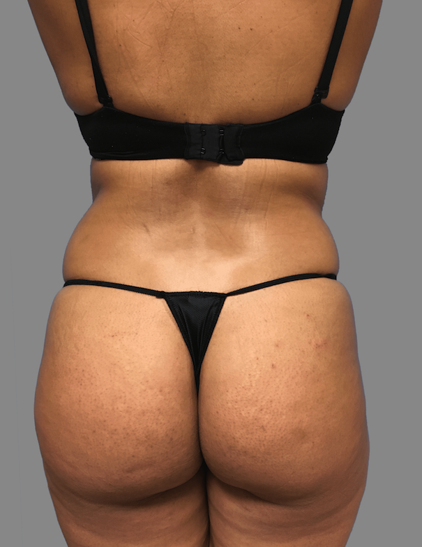 Brazilian Butt Lift Before & After Patient #1444
