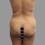 Brazilian Butt Lift Before & After Patient #1456