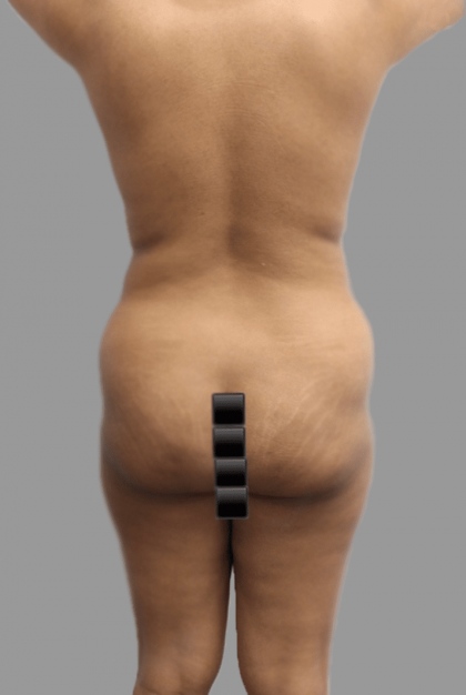 Brazilian Butt Lift Before & After Patient #1456