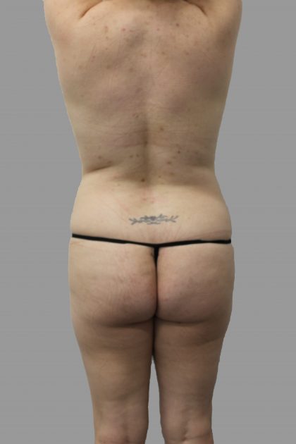 Brazilian Butt Lift Before & After Patient #1447
