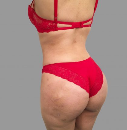 Brazilian Butt Lift Before & After Patient #1421