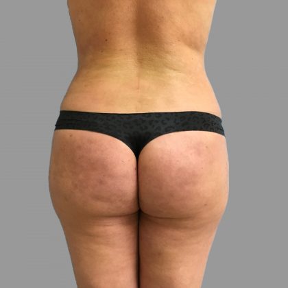 Brazilian Butt Lift Before & After Patient #1453